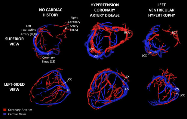 Coronary Arteries