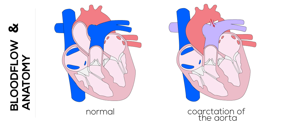 Coarctication of the Aorta