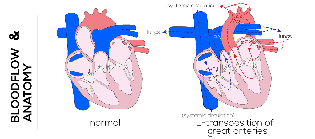 Congenitally "Corrected" Transposition of Great Arteries