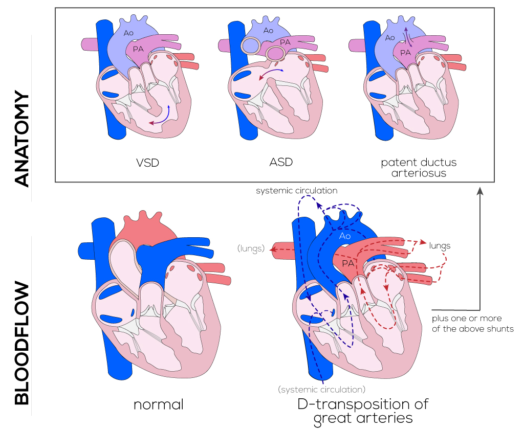 D-Transposition of the Great Arteries