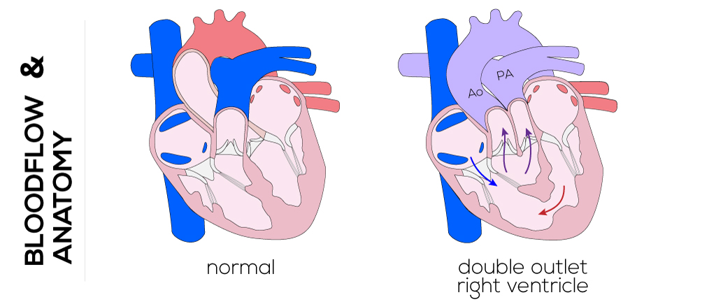 Double Outlet Right Ventricle