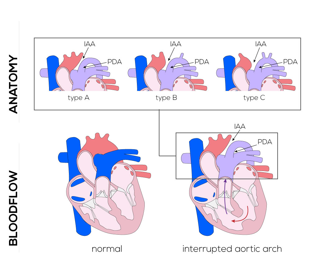 Interrupted Aortic Arch