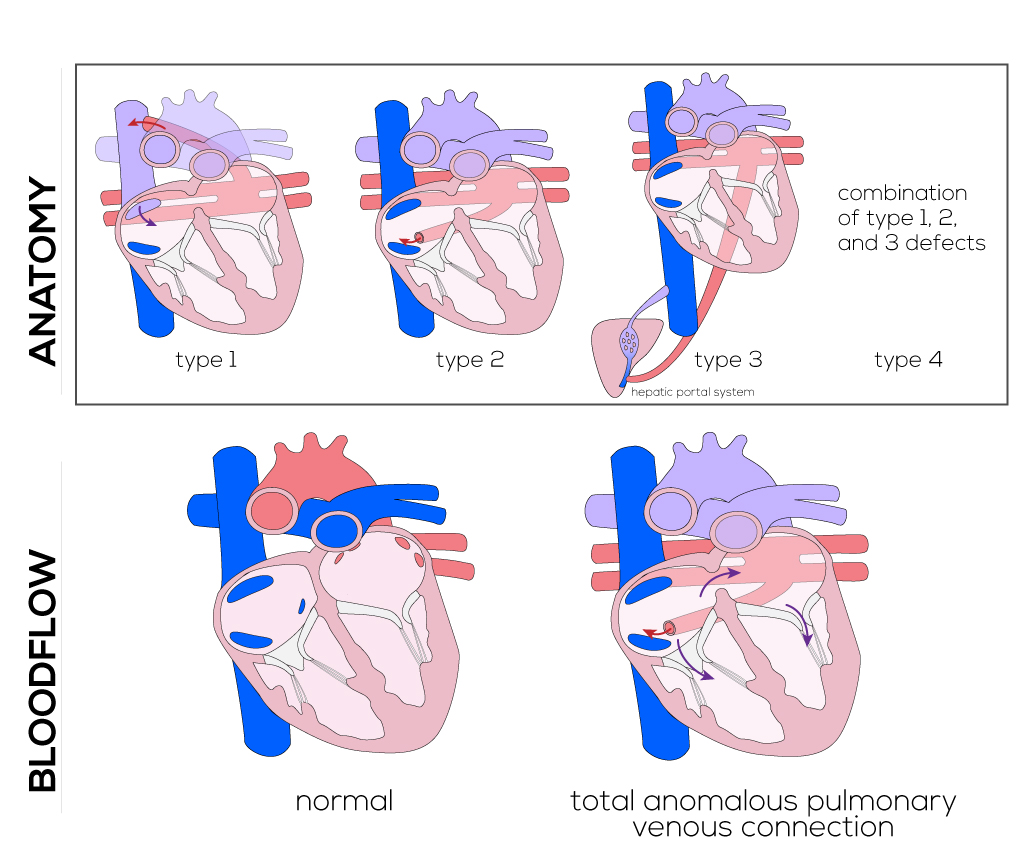 Anomalous Pulmonary Venous Connection
