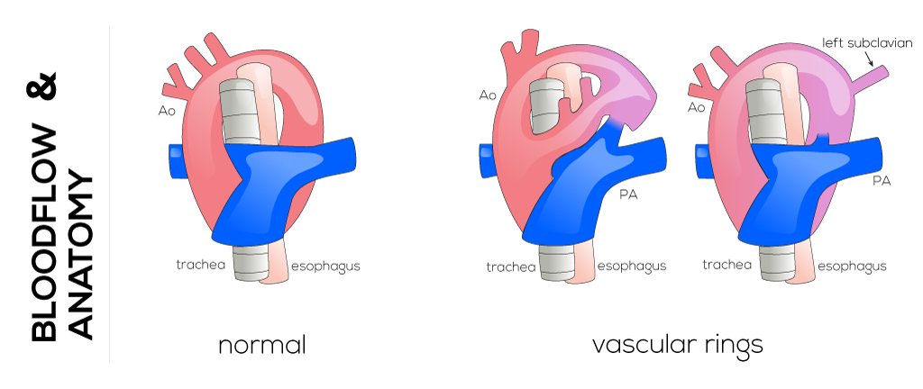 Vascular Rings and Slings