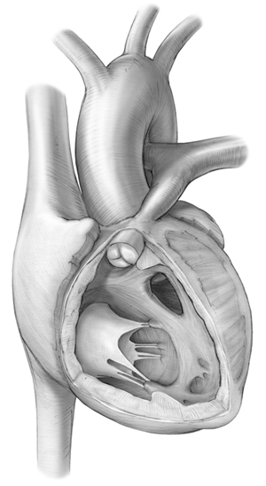 Four components of Tetralogy of Fallot