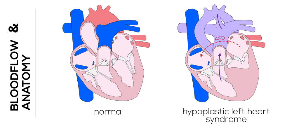 Pulmonary Stenosis