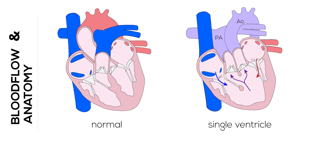 Single Ventricle