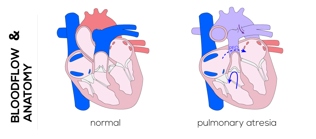 Pulmonary Atresia