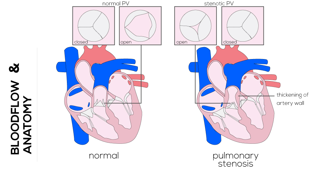 pulmonary valve