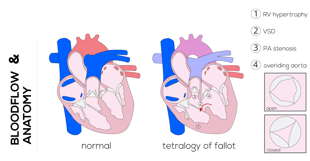 Tetralogy of Fallot