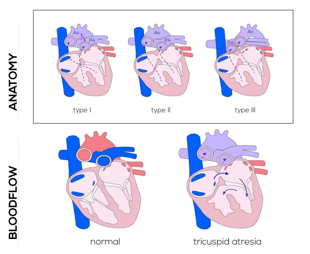 Tricuspid Atresia