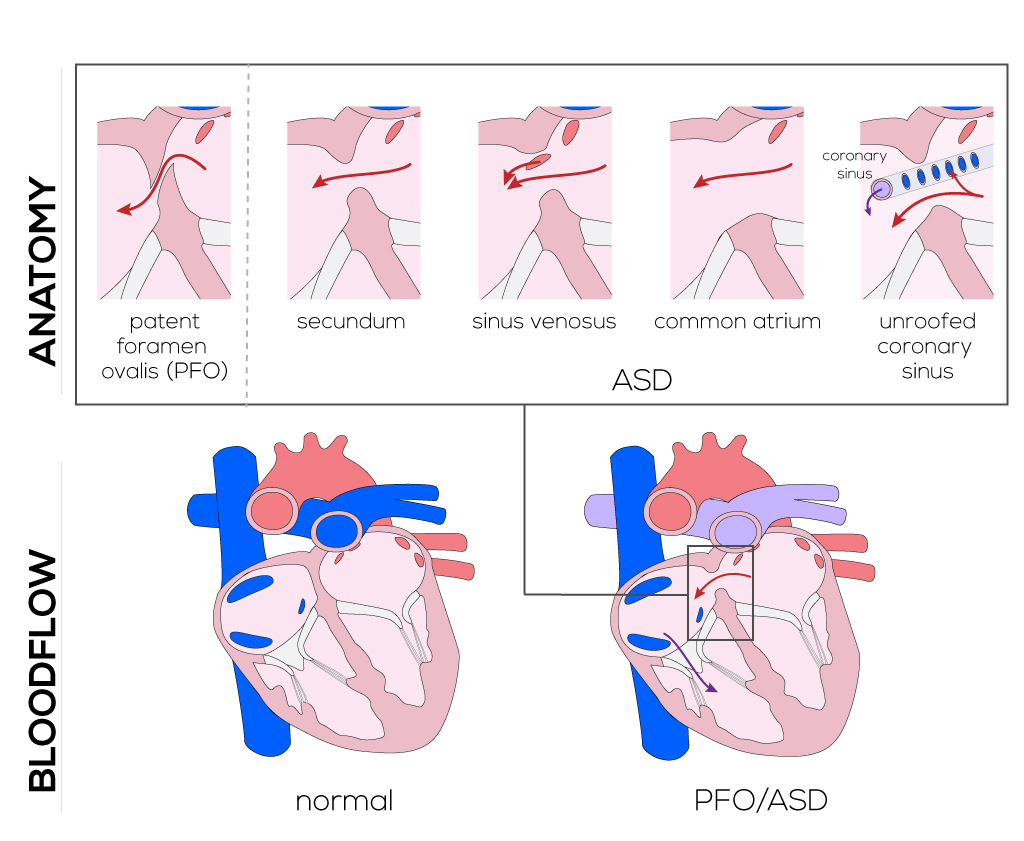 Atrial septal defects