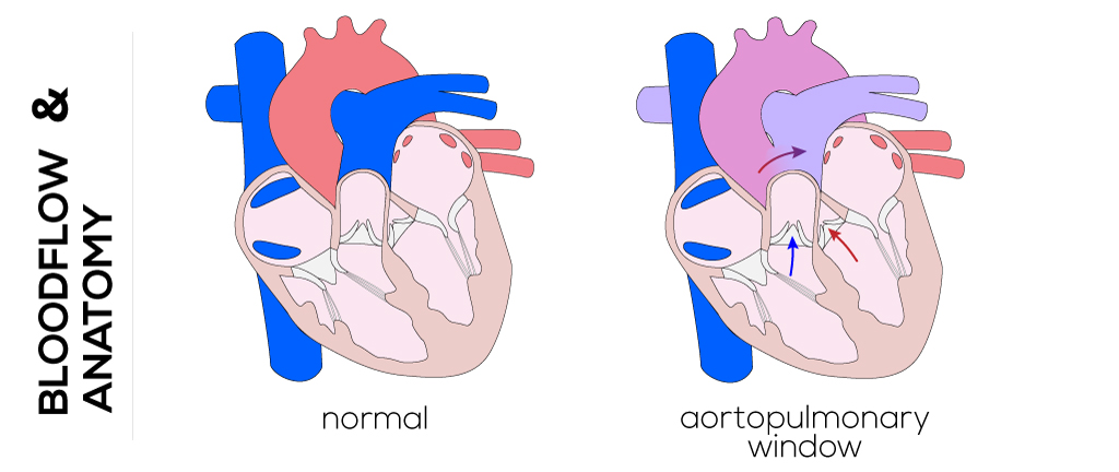Aortopulmonary Window (APW) Defects