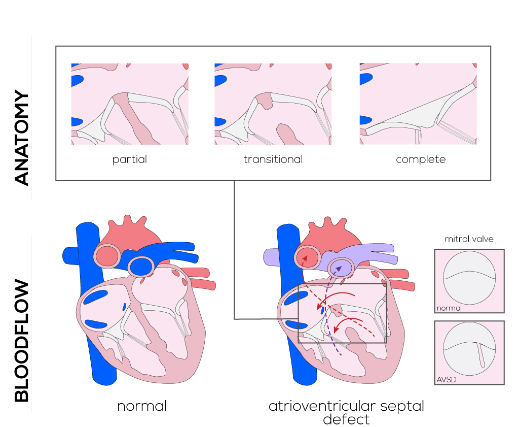 Atrioventricular Septal Defects