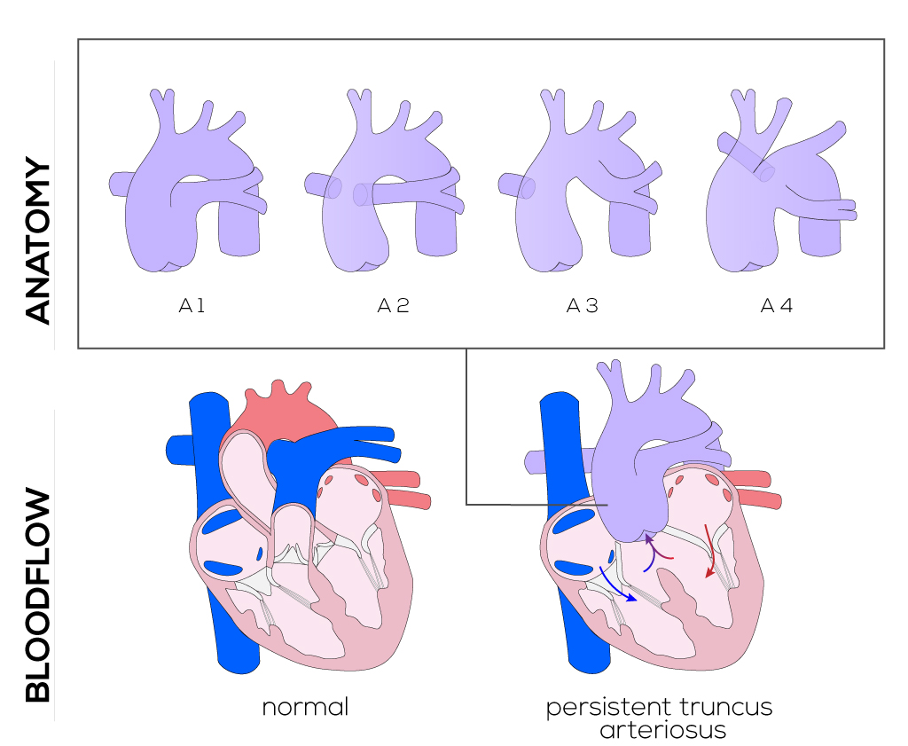 Persistent Truncus Arteriosus