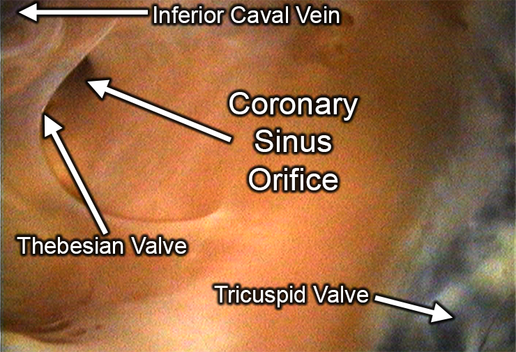 Inside Coronary Sinus