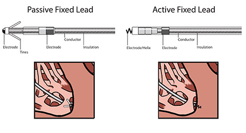 Passive Active Fix Leads