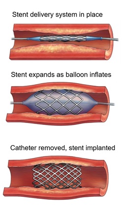 Stent Delivery