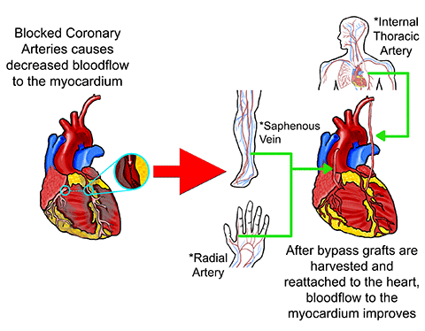 Coronary Bypass