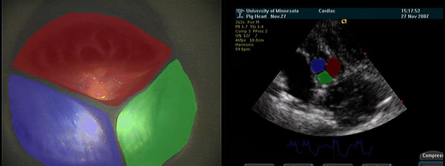 Aortic Valve