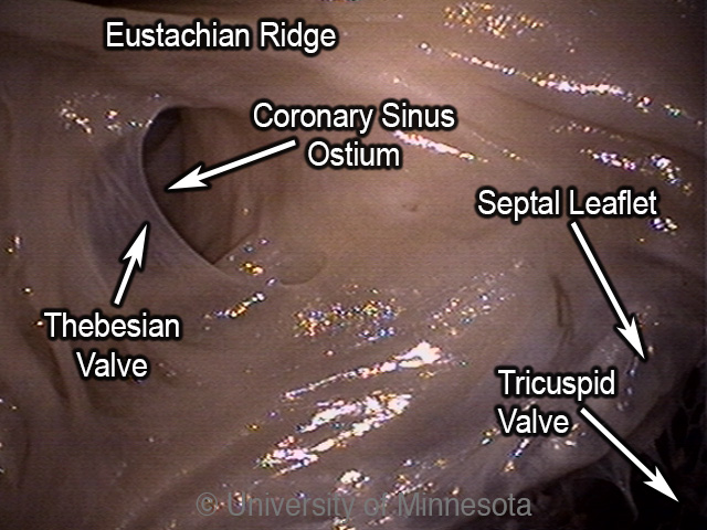 Heart0016 Perfusion Fixed Right Atrium Coronary Sinus Ostium