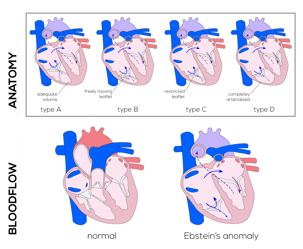 Fluid–structure interaction simulation of pathological mitral valve  dynamics in a coupled mitral valve-left ventricle model | Intelligent  Medicine