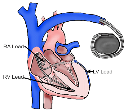 Cardiac Resynchronization Therapy System