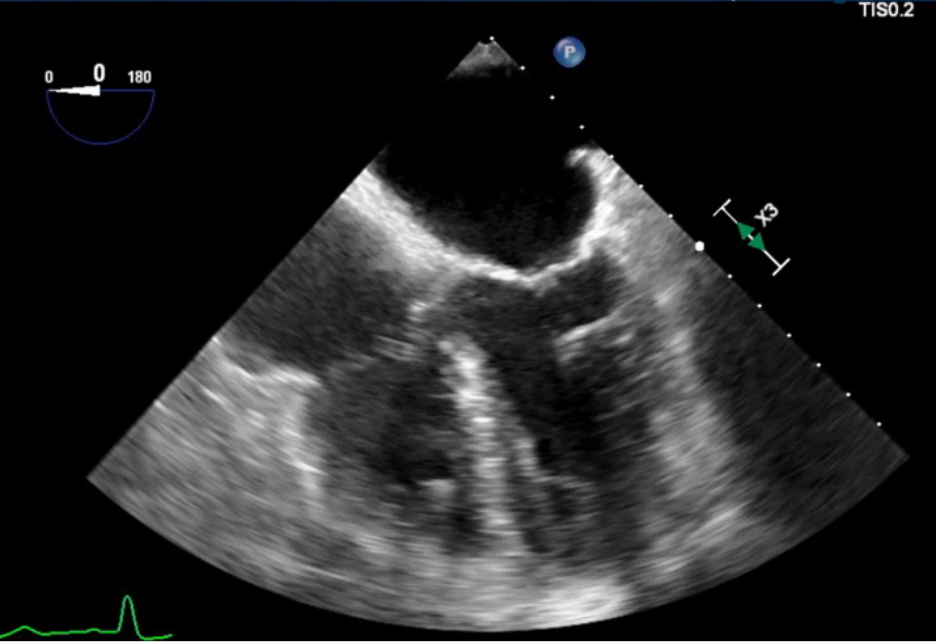 Echocardiography Tutorial - Echocardiographic Modes