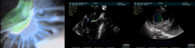 Mitral Valve