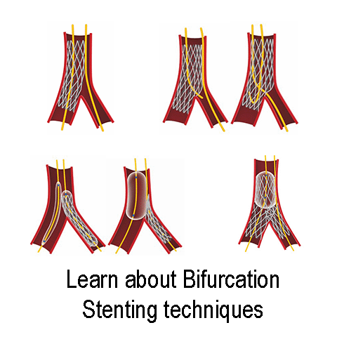 Learn about bifurcation stenting techniques